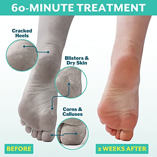 Patchology PoshPeel Pedi Cure - Foot Peel Mask Soak Treatment, Feet Peeling Mask, Pedicure Booties with Deep Exfoliation for Baby-soft Skin, Pedicure Supplies for Foot Care, 1 Pair