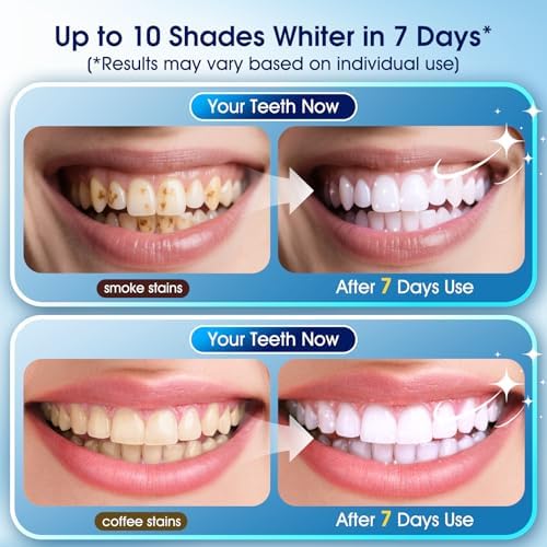 Teeth Whitening Kit with LED Light – 3 Whitening Gel Pens + 2 Desensitizing Pens – 35% Carbamide Peroxide – Whiten Teeth in 7 Days – Safe for Sensitive Teeth & Enamel（Mint Flavor）