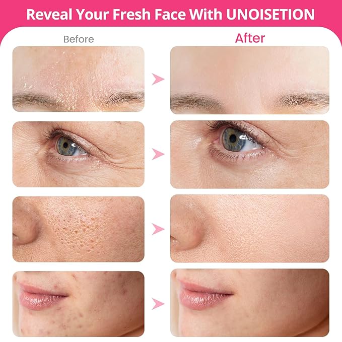 At-home Microdermabrasion Machine, UNOISETION 3 in 1 Dermabrasion Facial Machine for Exfoliation & Blackhead Removal