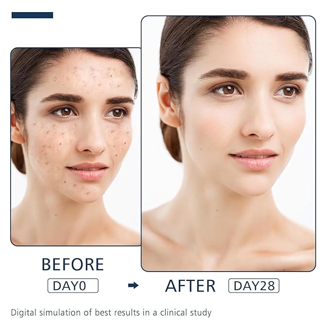 Dark Spot Remover for Face and Body - Dark Spot Advanced Corrector Serum for Melasma, Age Spots, Freckles & Sun Spots, with 360° Roller for All Skin Types (0.67 fl. oz)